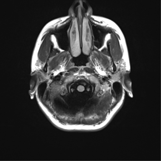 File:Cerebellar agenesis with hypoplastic pons (pontocerebellar hypoplasia) (Radiopaedia 57224-64138 Axial FLAIR 4).png