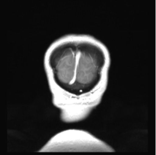 Cerebellar ependymoma complicated by post-operative subdural hematoma (Radiopaedia 83322-97736 Coronal T1 C+ 56).png