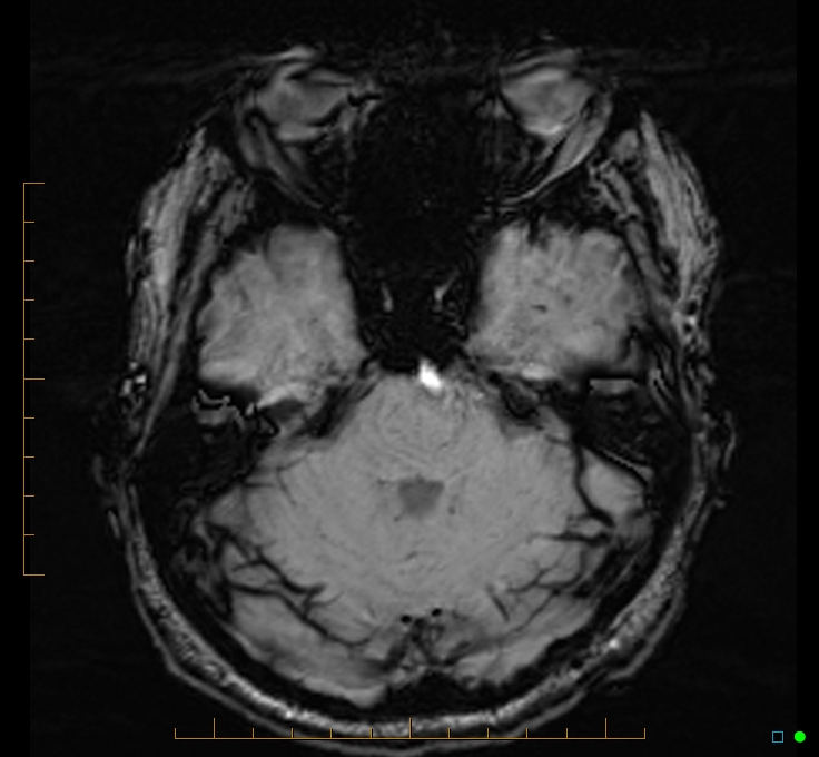 Cerebellar gangliocytoma (Radiopaedia 65377-74422 Axial SWI 16).jpg