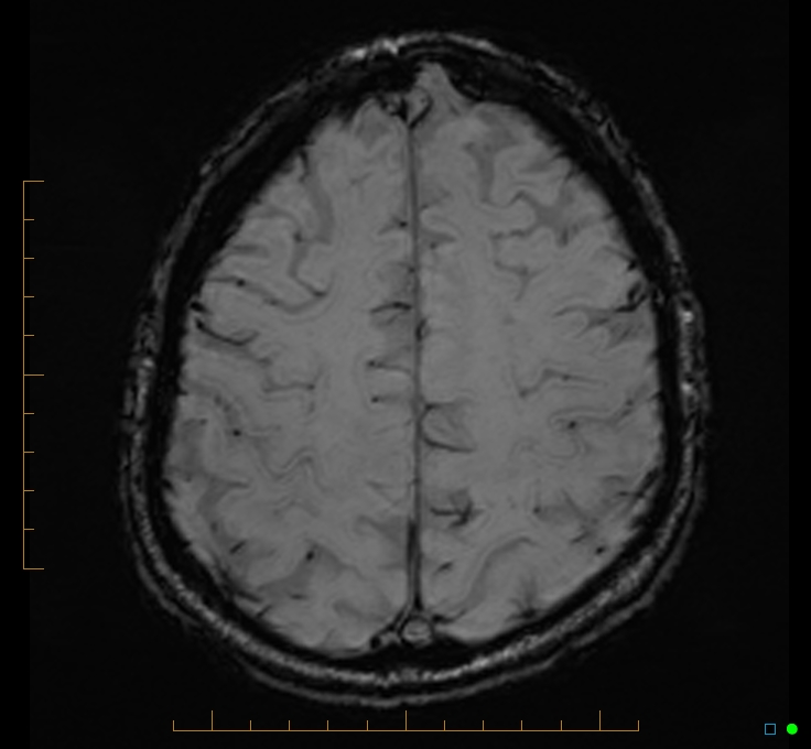 Cerebellar gangliocytoma (Radiopaedia 65377-74422 Axial SWI 46).jpg