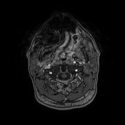Cerebellar hemangioblastoma (Radiopaedia 88055-104622 Axial T1 C+ 12).jpg