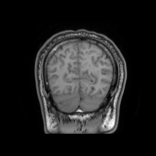 File:Cerebellar hemangioblastoma (Radiopaedia 88055-104622 Coronal T1 31).jpg