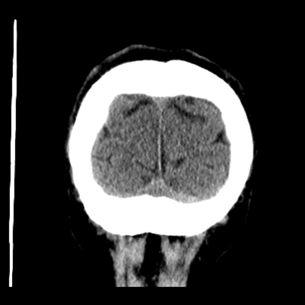 Cerebellar hemorrhage (Radiopaedia 27193-27359 Coronal non-contrast 52).jpg
