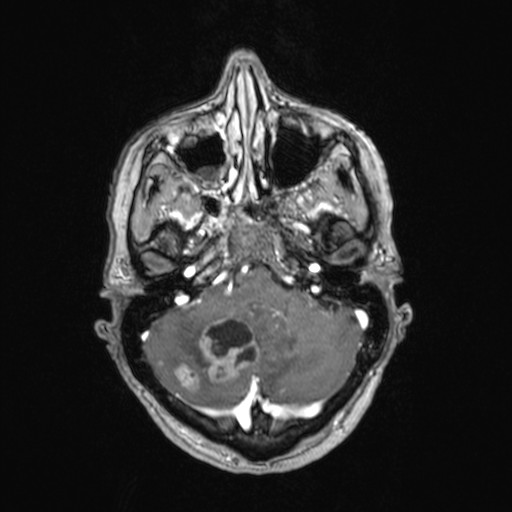 Cerebellar metastases (Radiopaedia 24038-24249 Axial T1 C+ 42).jpg