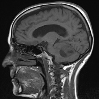 File:Cerebellar metastases (Radiopaedia 24038-24249 Sagittal T1 10).jpg