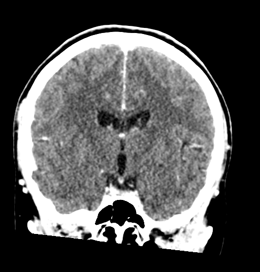 Cerebellar metastases - colorectal adenocarcinoma (Radiopaedia 40947-43652 Coronal C+ 45).png