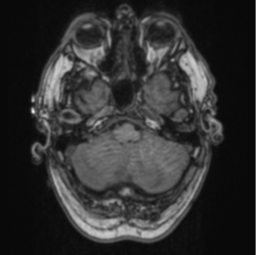 File:Cerebellar metastasis from lung adenocarcinoma (Radiopaedia 86690-102829 Axial T1 19).png