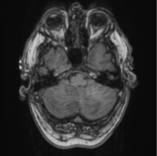 Cerebellar metastasis from lung adenocarcinoma (Radiopaedia 86690-102829 Axial T1 20).png
