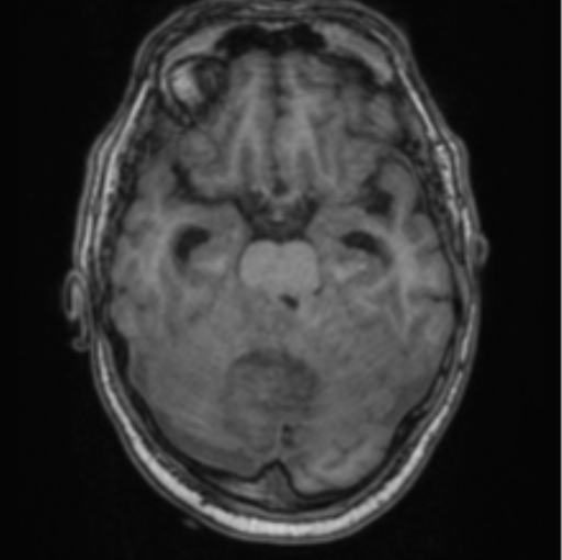 Cerebellar metastasis from lung adenocarcinoma (Radiopaedia 86690-102829 Axial T1 30).png