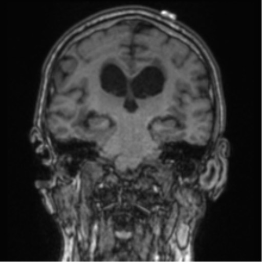 Cerebellar metastasis from lung adenocarcinoma (Radiopaedia 86690-102829 Coronal T1 48).png