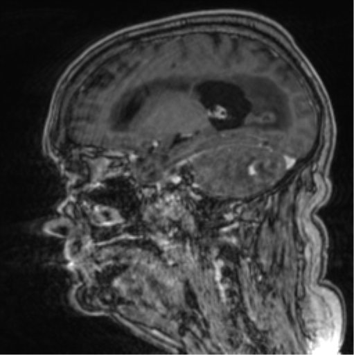 Cerebellar metastasis from lung adenocarcinoma (Radiopaedia 86690-102829 Sagittal T1 C+ 53).png