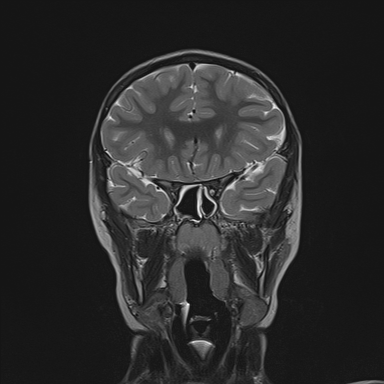File:Cerebellar stroke (Radiopaedia 32202-33150 Coronal T2 9).png