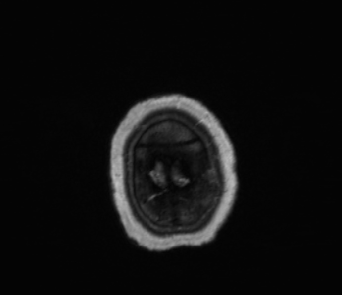 Cerebellopontine angle meningioma (Radiopaedia 35181-36715 Axial T1 C+ 5).jpg