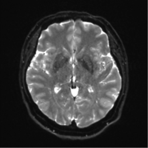 Cerebellopontine angle meningioma (Radiopaedia 48434-53348 Axial DWI 20).png