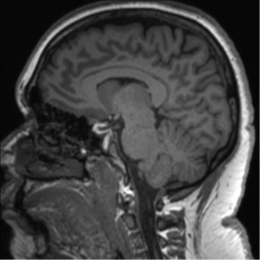 Cerebellopontine angle meningioma (Radiopaedia 48434-53348 Sagittal T1 51).png