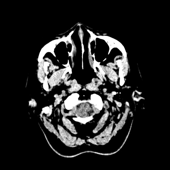 Cerebellopontine angle meningioma (Radiopaedia 53561-59592 Axial non-contrast 4).jpg