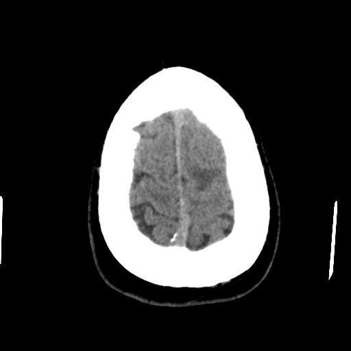 Cerebral abscess (Radiopaedia 29451-29919 Axial non-contrast 45).jpg