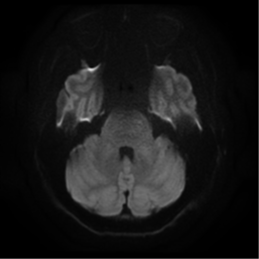 Cerebral abscess (Radiopaedia 57774-64740 Axial DWI 7).png