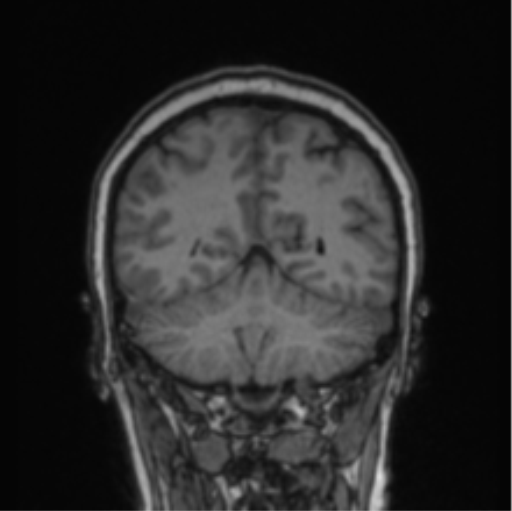 File:Cerebral abscess from pulmonary arteriovenous malformation (Radiopaedia 86275-102291 Coronal T1 28).png