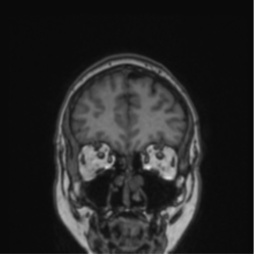 Cerebral abscess from pulmonary arteriovenous malformation (Radiopaedia 86275-102291 Coronal T1 72).png