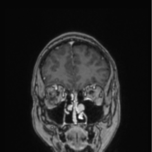 Cerebral abscess from pulmonary arteriovenous malformation (Radiopaedia 86275-102291 L 72).png