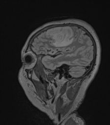 Cerebral abscess from pulmonary arteriovenous malformation (Radiopaedia 86275-102291 Sagittal FLAIR 58).png