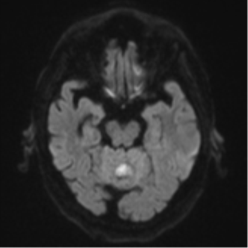 Cerebral abscesses- medically managed (Radiopaedia 45183-49179 Axial DWI 39).png