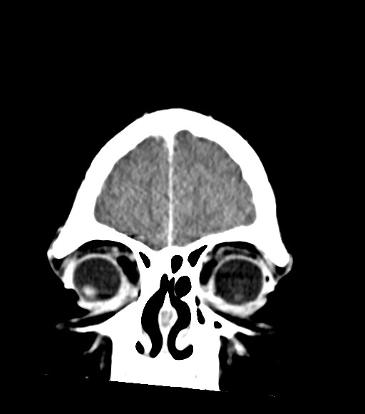 Cerebral abscesses (Radiopaedia 70458-80568 Coronal Contrast 11).jpg