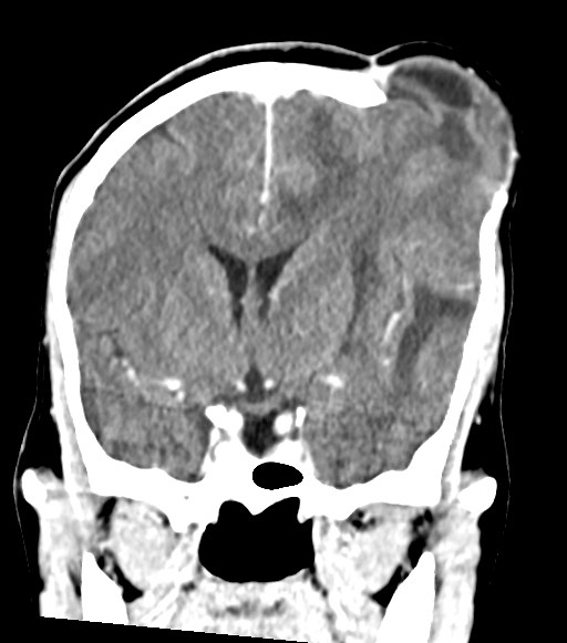 Cerebral abscesses (Radiopaedia 70458-80568 Coronal Contrast 29).jpg