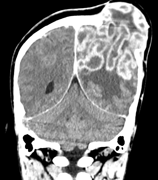 Cerebral abscesses (Radiopaedia 70458-80568 Coronal Contrast 48).jpg