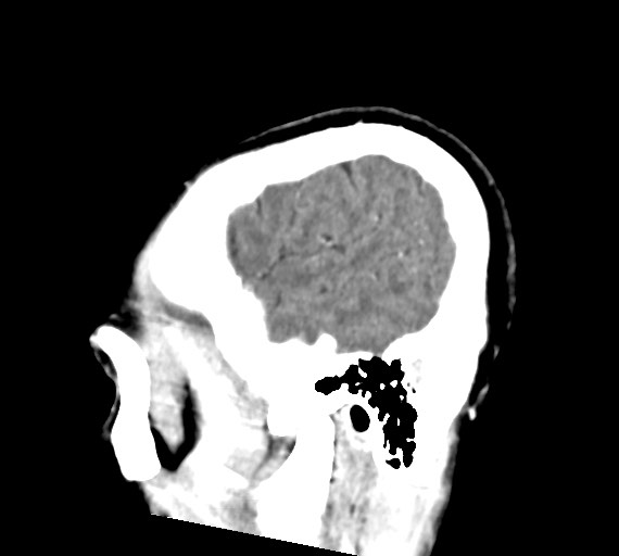 Cerebral abscesses (Radiopaedia 70458-80568 Sagittal Contrast 47).jpg