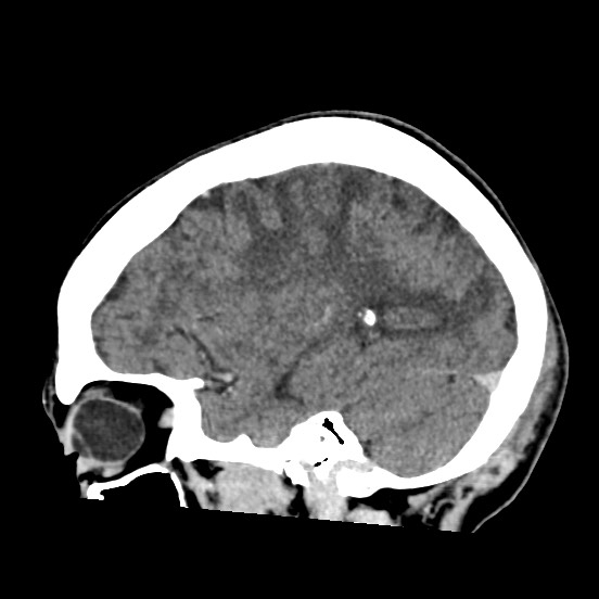 Cerebral amyloid angiopathy-related inflammation (Radiopaedia 74836-85848 C 43).jpg