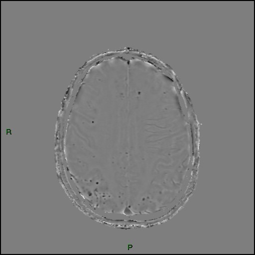 Cerebral amyloid angiopathy (Radiopaedia 77506-89664 H 72).jpg