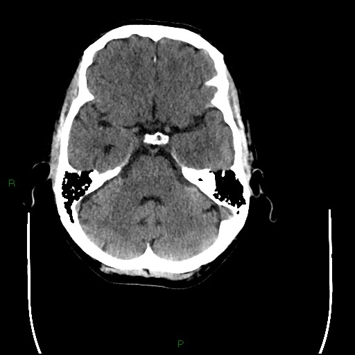 Cerebral amyloid angiopathy (Radiopaedia 77506-89665 Axial non-contrast 31).jpg