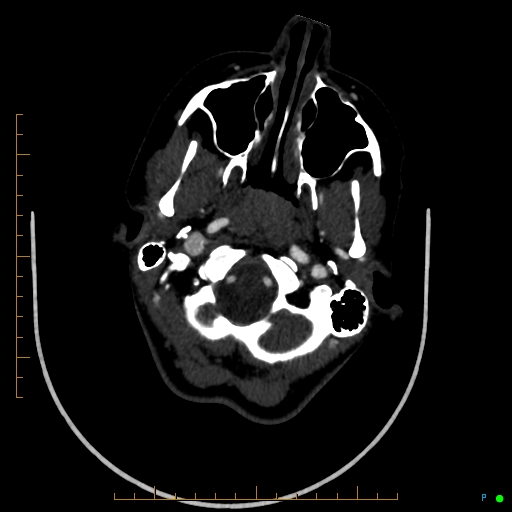 Cerebral arteriovenous malformation (AVM) (Radiopaedia 78162-90706 Axial CTA 48).jpg