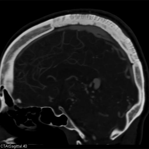 Cerebral arteriovenous malformation (Radiopaedia 28518-28759 D 37).jpg