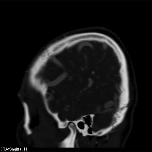 Cerebral arteriovenous malformation (Radiopaedia 28518-28759 D 8).jpg