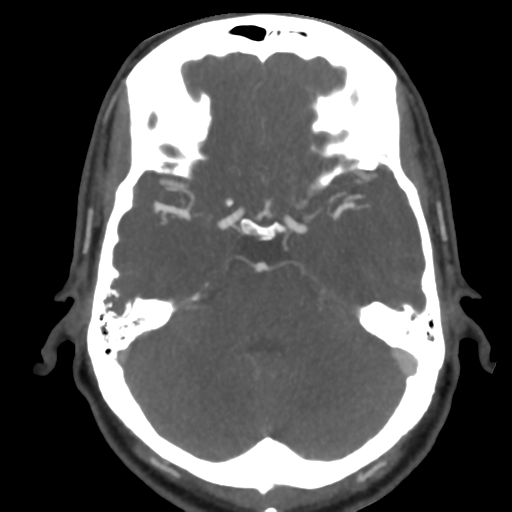 File:Cerebral arteriovenous malformation (Radiopaedia 39259-41505 AX CEREBRAL CTA 18).png