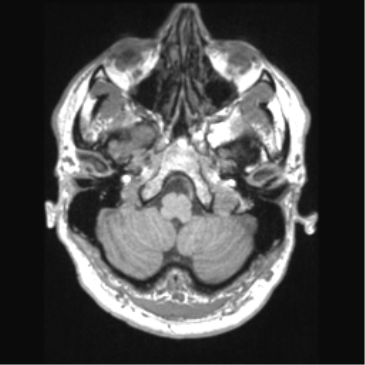 Cerebral arteriovenous malformation (Radiopaedia 39259-41506 Axial T1 15).png
