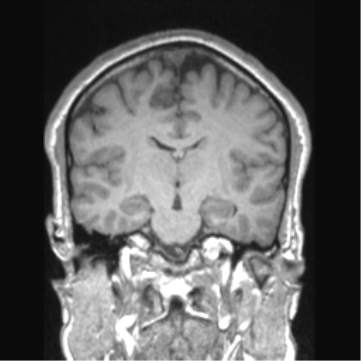 Cerebral arteriovenous malformation (Radiopaedia 39259-41506 Coronal T1 47).png