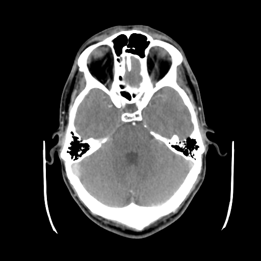 Cerebral arteriovenous malformation (Radiopaedia 55798-62371 B 16).png
