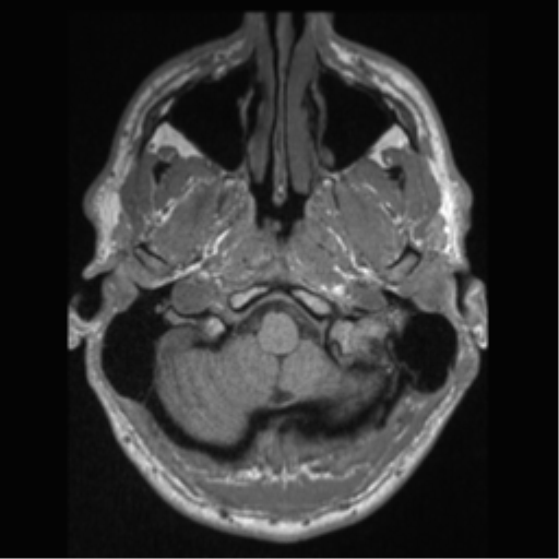 Cerebral arteriovenous malformation (Radiopaedia 55798-62372 Axial T1 3).png