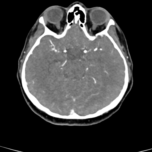 File:Cerebral arteriovenous malformation (Radiopaedia 73830-84645 B 61).jpg
