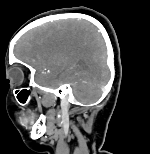 Cerebral arteriovenous malformation (Radiopaedia 73830-84645 D 27).jpg