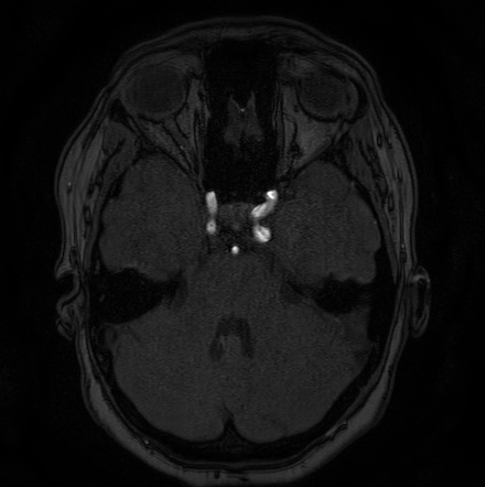 Cerebral arteriovenous malformation (Radiopaedia 74411-85654 Axial MRA 30).jpg