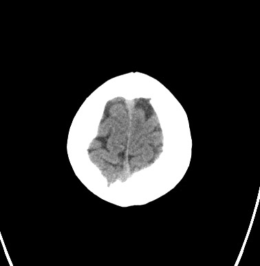 File:Cerebral arteriovenous malformation (Radiopaedia 74411-85744 Axial non-contrast 33).jpg