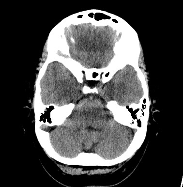 File:Cerebral arteriovenous malformation (Radiopaedia 74411-85744 Axial non-contrast 7).jpg