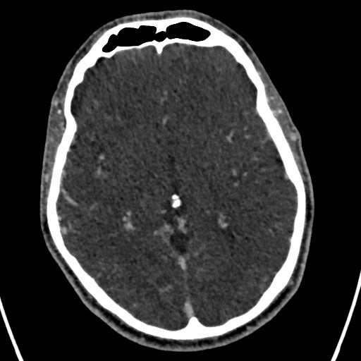 Cerebral arteriovenous malformation (Radiopaedia 78188-90746 Axial C+ delayed 84).jpg