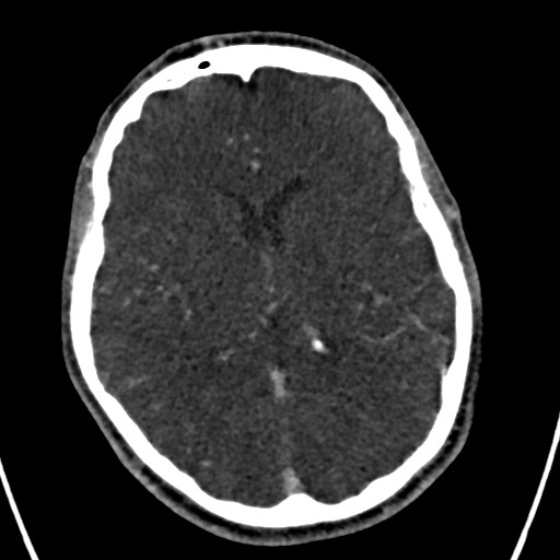 Cerebral arteriovenous malformation (Radiopaedia 78188-90746 Axial C+ delayed 96).jpg