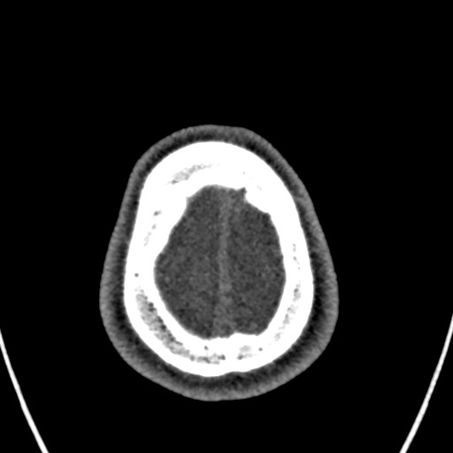 Cerebral arteriovenous malformation (Radiopaedia 78188-90746 Axial non-contrast 167).jpg
